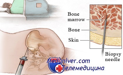 Что такое трепанобиопсия. Трепанобиопсия костного мозга. Трепан биопсия костного мозга. Трепанобиопсия пунктат костного мозга. Трепан биопсия подвздошной кости.